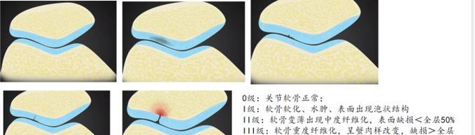 髌骨软骨cf手术费用多少？术后恢复需要注意什么？  第2张